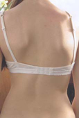 15 year old girl with Scoliosis - before treatment